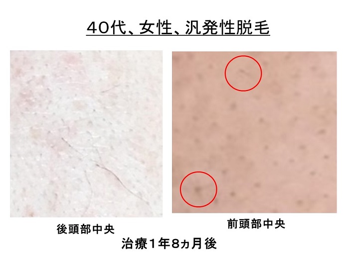 円形脱毛症　病院